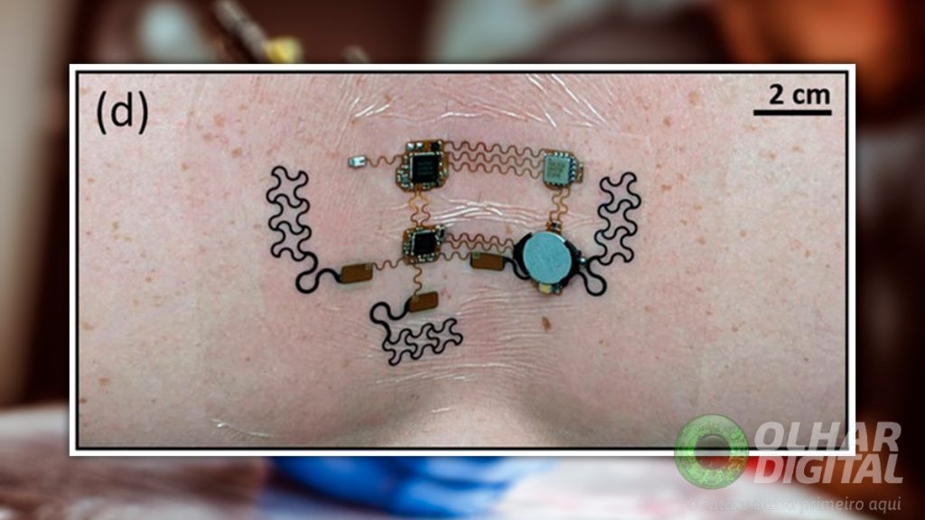 Tatuagem eletrônica em peito de paciente